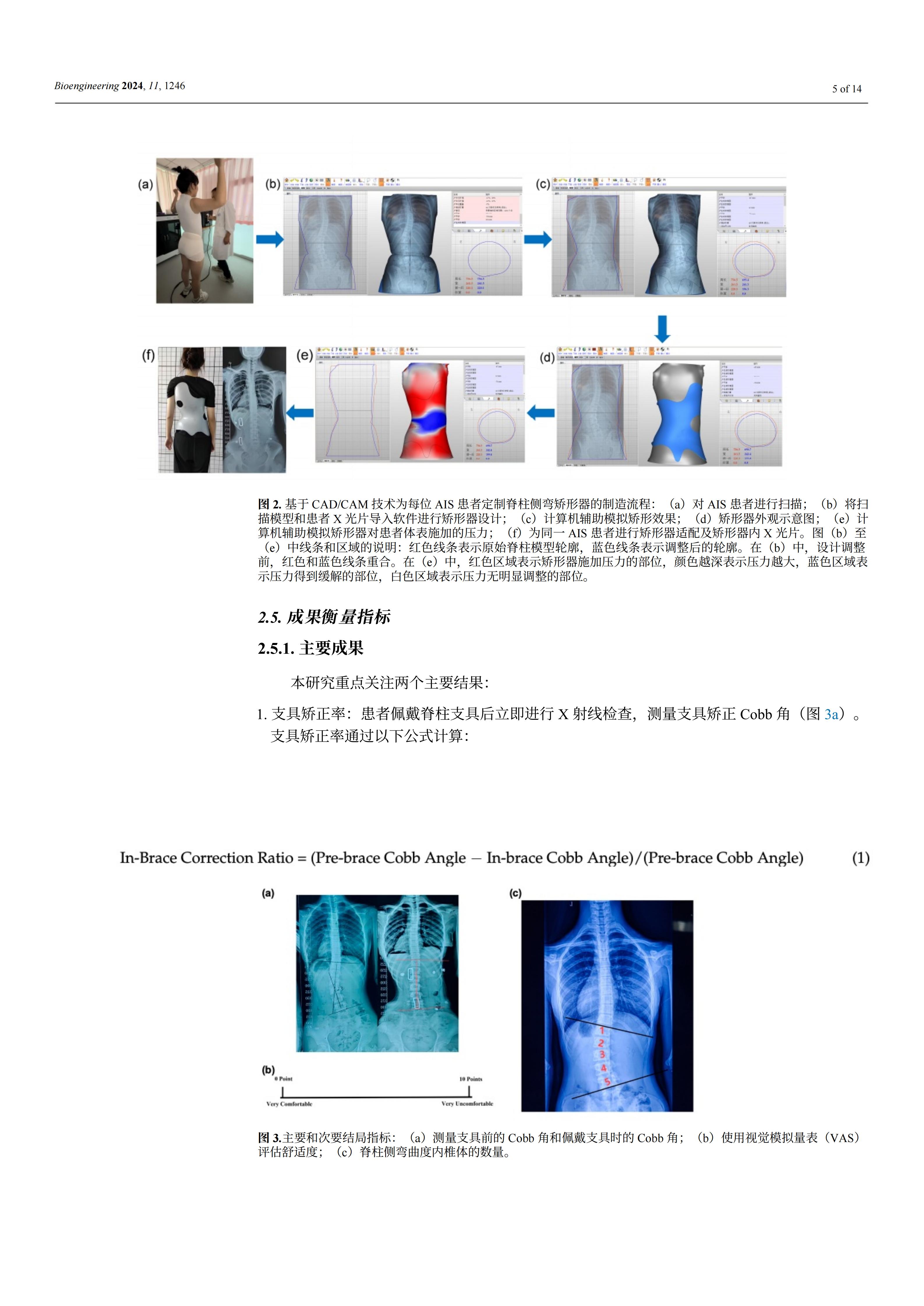 使用新型3D脊柱減壓和矯正裝置能夠顯著提高青少年特發(fā)性脊柱側(cè)彎患者佩戴支具時(shí)的矯正效果和舒適度